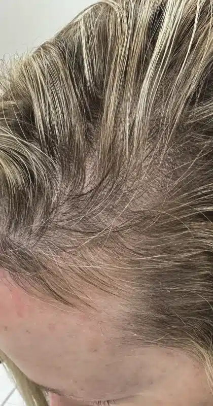 Why Are You Losing Hair? Common Causes And What To Do First