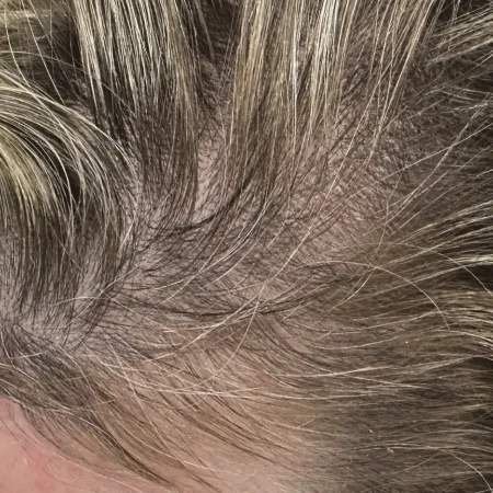 Why Are You Losing Hair? Common Causes And What To Do First