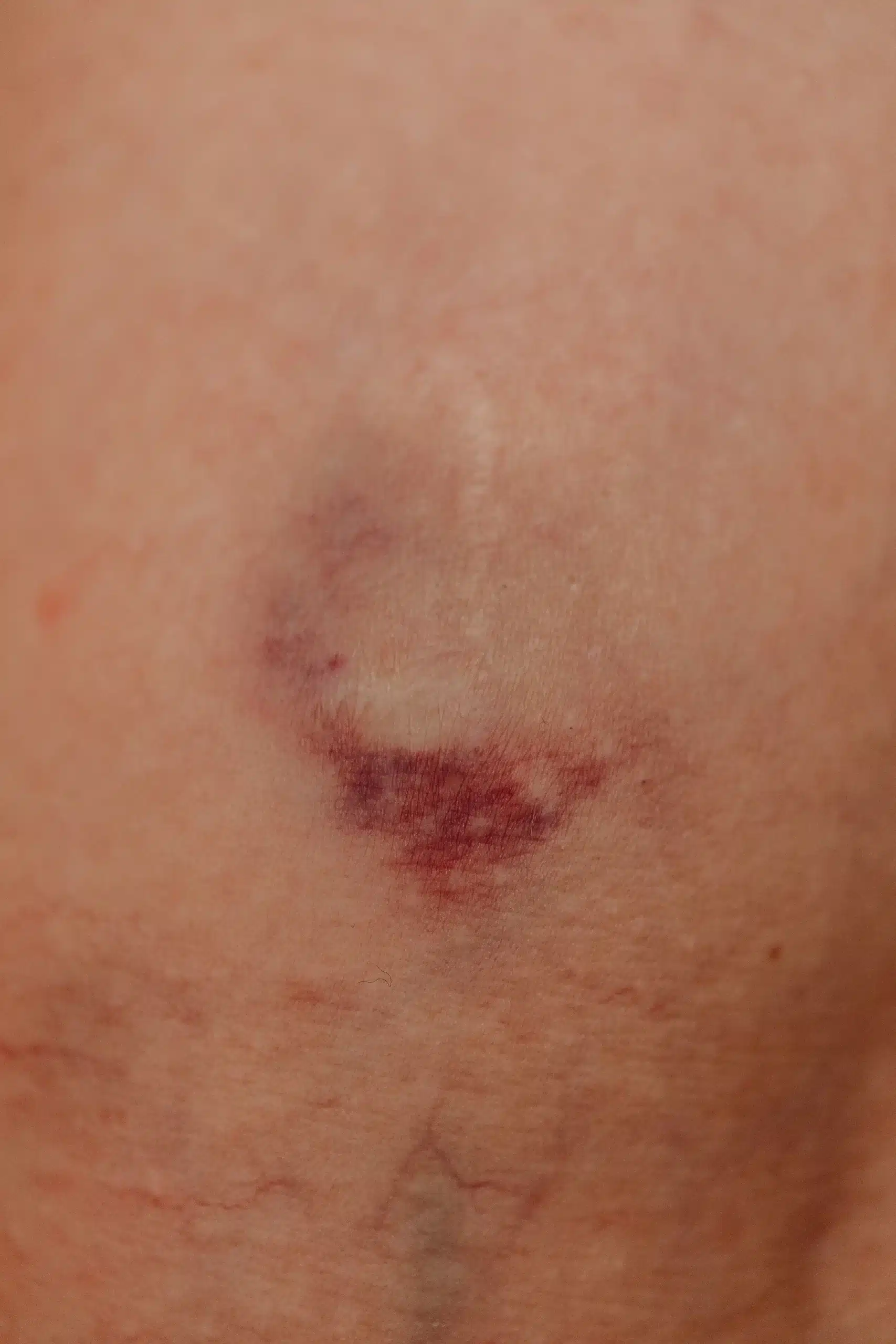 can vascular occlusion happen days after filler