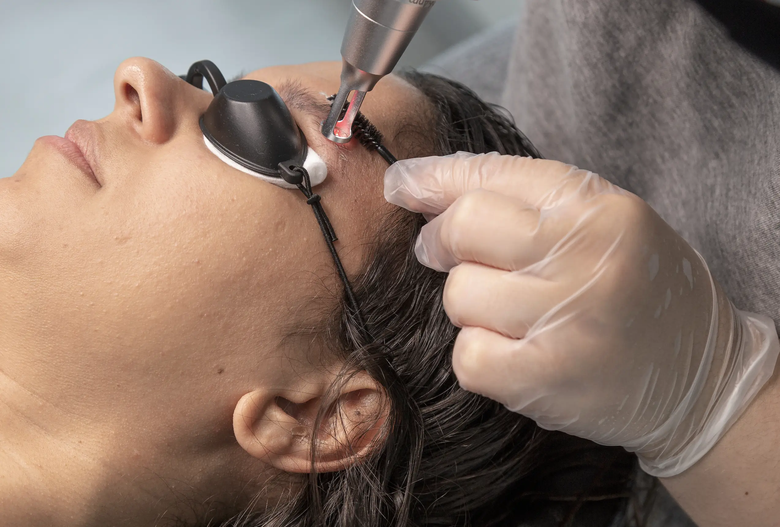 tattoo considerations before laser procedures