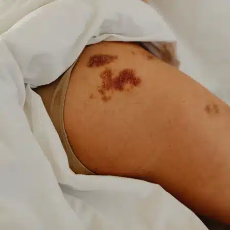dusky skin after dermal filler