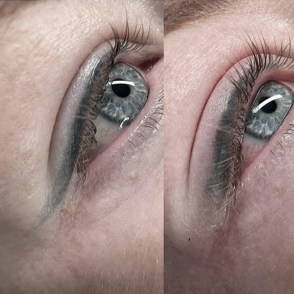 brisbane eyeliner tattoo removal