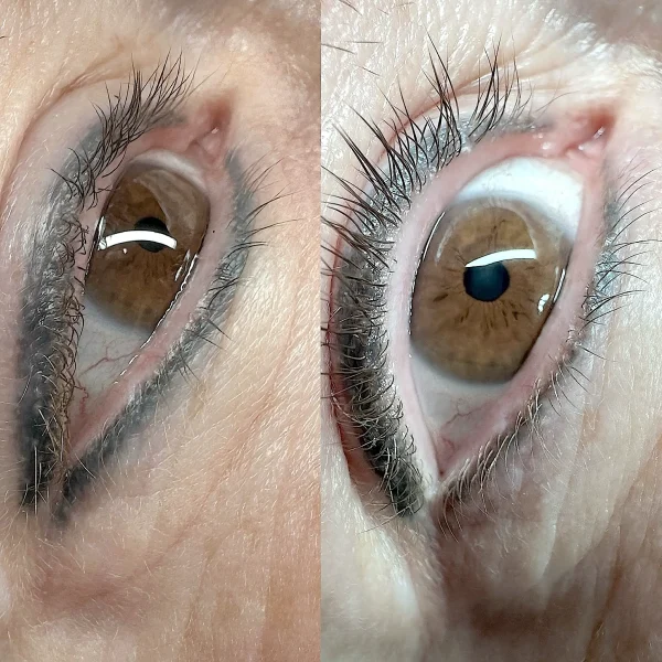 eyeliner tattoo removal artist