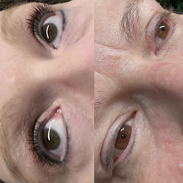 eyeliner tattoo removal brisbane