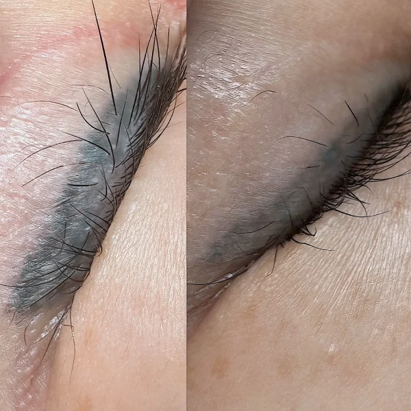 eyeliner tattoo removal clinic