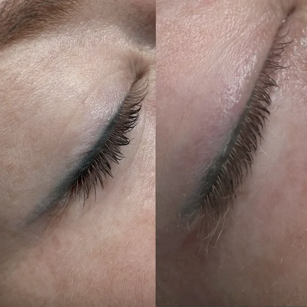 eyeliner tattoo removal cost
