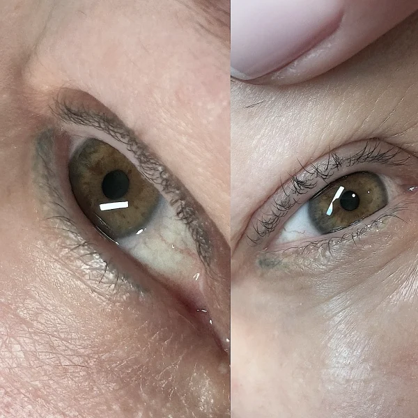 eyeliner tattoo removal near me