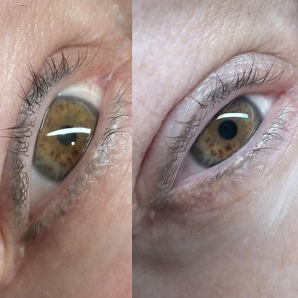 eyeliner tattoo removal price