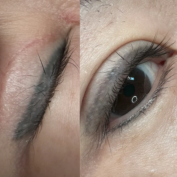 eyeliner tattoo removal