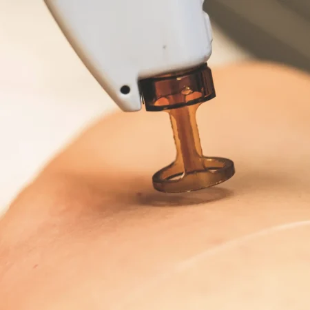how candela lasers work hair removal