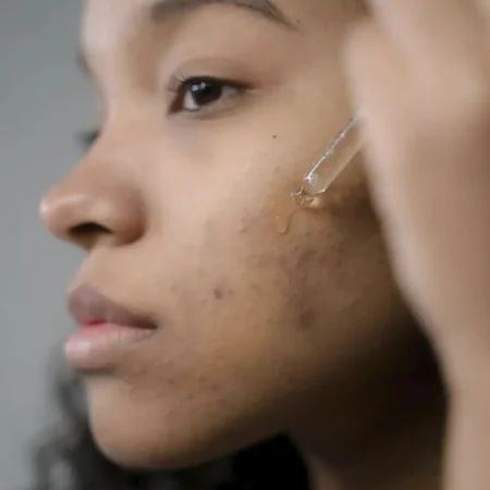how to avoid hyperpigmentation after procedures