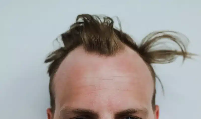 male pattern baldness genetics