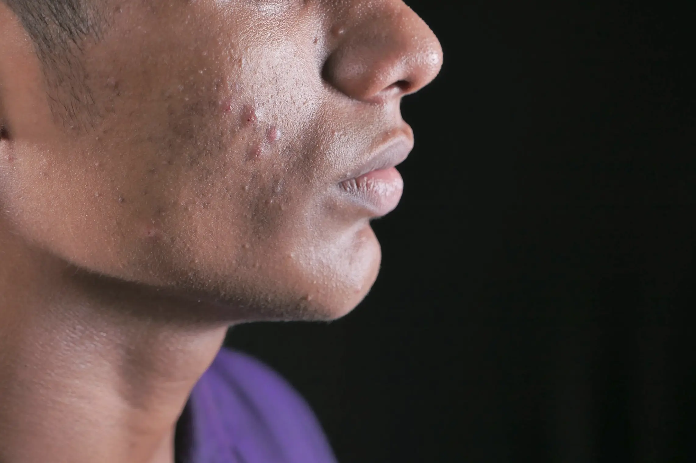 post procedure skincare to prevent pigmentation