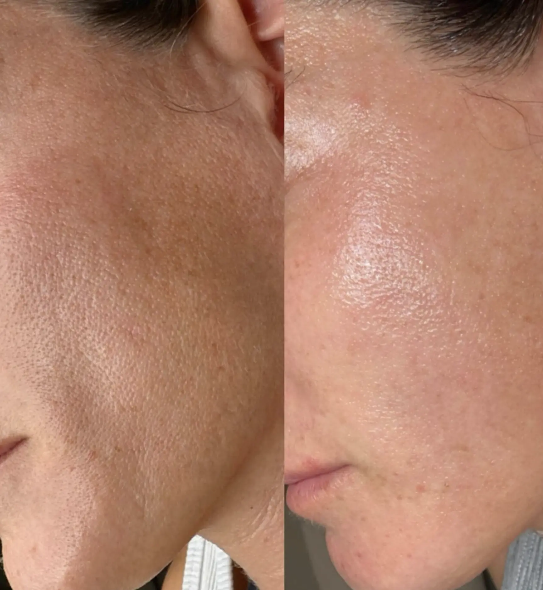 rf skin resurfacing vs skin needling